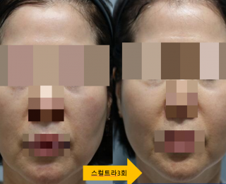 전후사진